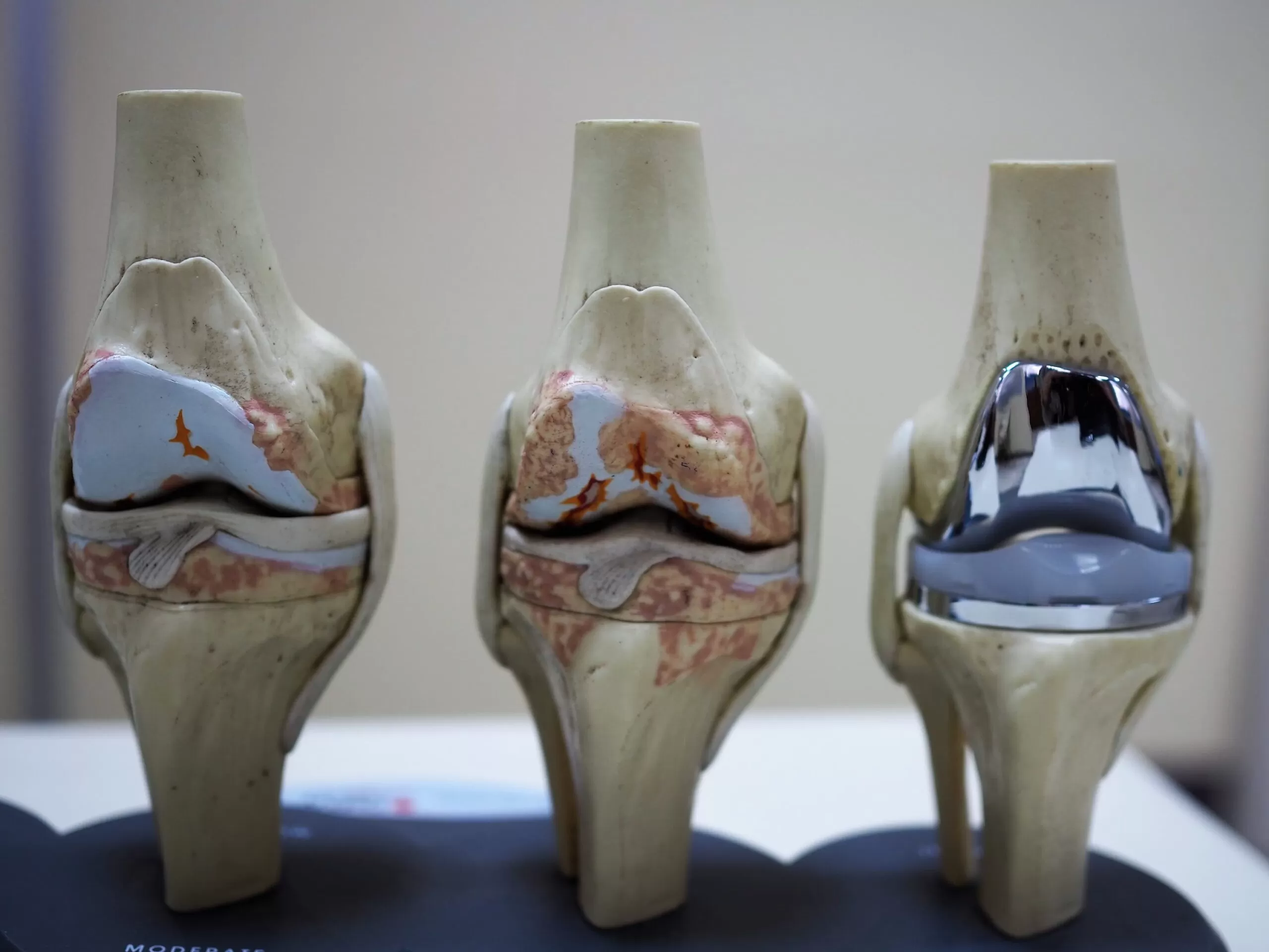 Total Knee Replacement